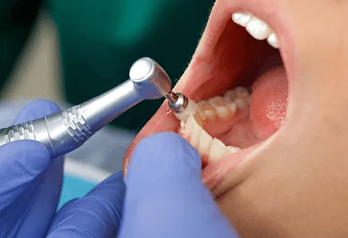 What Does a Dental Cleaning Actually Remove? What Does a Dental Cleaning Actually Remove